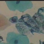 Ομάδα κυττάρων ενδοτραχήλου